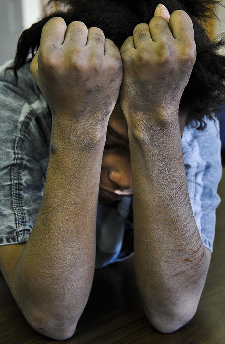 Portrait - 1st placeDenisha Fredrick, a confessed heroin addict who is going through withdrawl while serving time in the Clark County Jail, shows the track marks and scars on her arms and hands from injecting the illegal drug. (Bill Lackey / Springfield News-Sun)