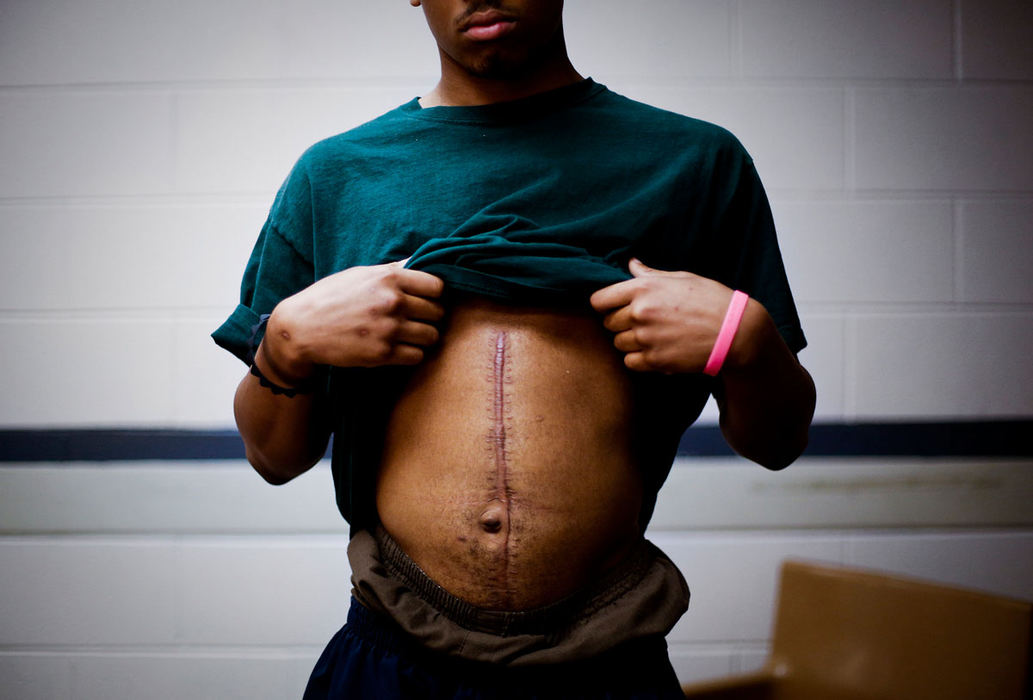 Story - 1st placeA 17-year-old Cleveland boy shows off the scar from the operation the doctors used to save his life after being shot in the chest and side at a party as he attends a session called Managing Anger and Violence in a close – or maximum – security unit at the Circleville Youth Detention Center. He woke up in detention due to violating his parole for carrying a weapon. Many of the teenagers at the detention center are repeat offenders in for violent crimes some of whom have shot other gang members or have been shot themselves.  (Eamon Queeney / The Columbus Dispatch)