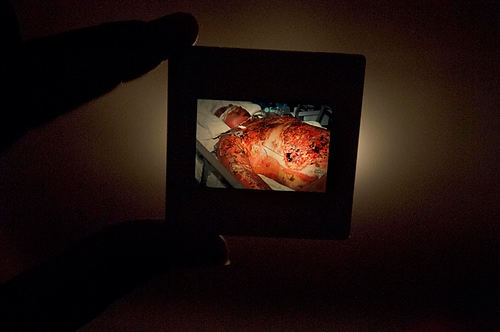 First place, Larry Fullerton Photojournalism Scholarship - Hannah Potes / Kent State UniversityKlavon holds a slide of a photo taken right after his accident. Seventy five percent of his body was severely burned. Doctors say it is a miracle he survived such a horrifying accident. 