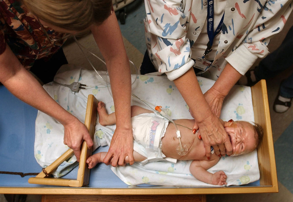 Second Place, Ohio Understanding Award - Bob DeMay / Akron Beacon JournalEthan gets fussy as nurses measure him as they prepare to discharge him from Akron Children's Hospital.