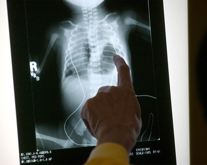 Second Place, Ohio Understanding Award - Bob DeMay / Akron Beacon JournalAkron Children's Hospital director of neonatology Dr Anand Kantak examines an chest x-ray of Cathy and Dana Moore's baby moments after birth. The baby's left lung is not near as developed as doctors had hoped for.