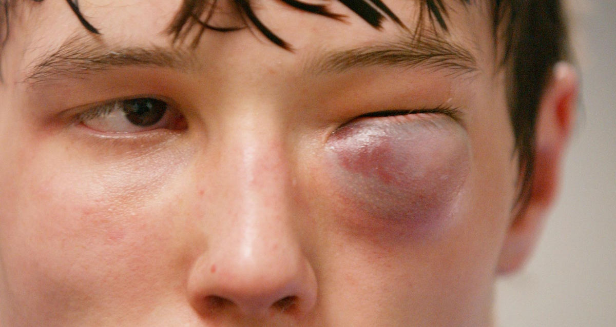 First Place, Photographer of the Year - John Kuntz / The Plain DealerJake Milton of Yellow Springs High School dons a swollen eye after his semi-final match during the Ohio High School State Wrestling Championships in Columbus. 