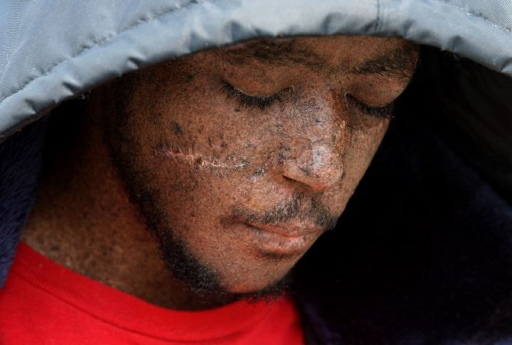 Award of Excellence, Portrait/Personality - Lynn Ischay / The Plain DealerFreckles, crusting and dry skin are signs of the genetic skin disorder that plagues Dontez Taylor's life. The scar is from his most recent skin-cancer surgery, his 28th. His skin is painfully sensitive to the sun, so he wears a hooded parka in the summer to protect himself.