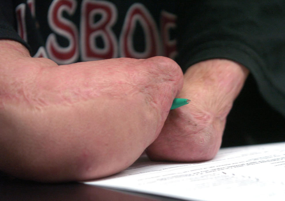 First Place, Sports Picture Story - Jeff Swinger / Cincinnati EnquirerWithout hands Dustin has to adapt to every day actions like holding a pen to take a Biology test.