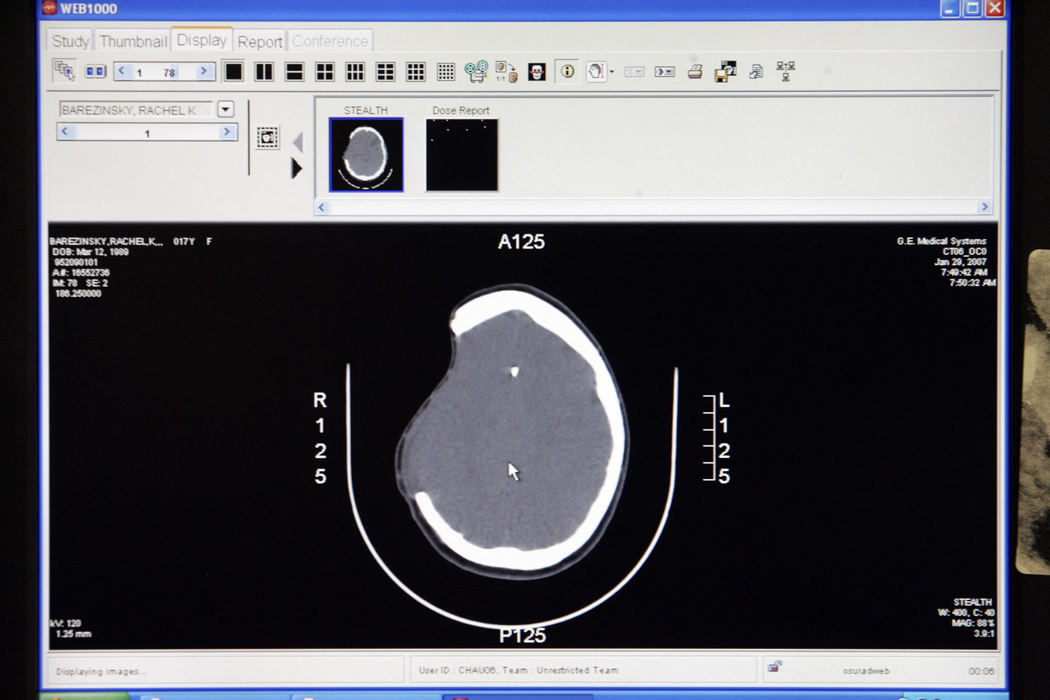 Third Place, Feature Picture Story - Shari Lewis / The Columbus DispatchA CAT scan shows the part of the skull that was removed to allow Rachel's brain to swell after the shooting. Seven months later, Rachel went into surgery to replace the missing piece.