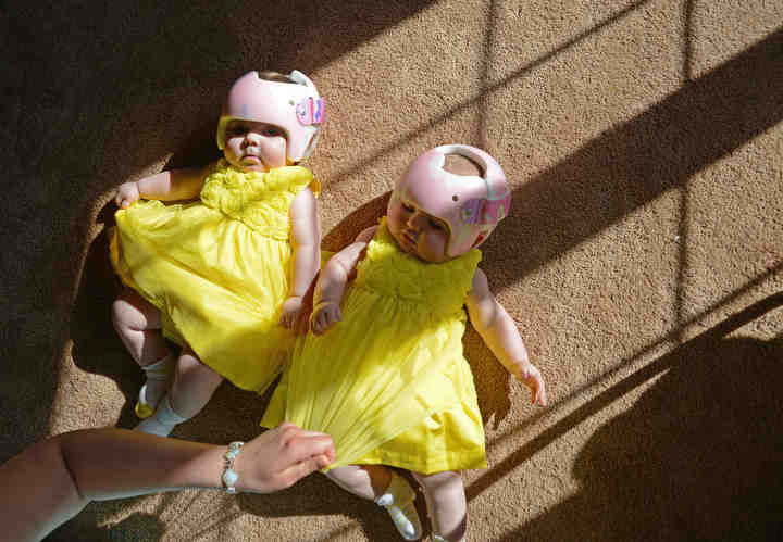 First Place, Larry Fullerton Photojournalism Scholarship - Jenna Watson / Kent State UniversityFour-month-old twins Roseline (left) and Sophia Lays (right) kick happily in the living room of their home as mother Andrea Lays fixes Sophia's dress. The babies were fitted with cranial shaping helmets one week prior that will aid in the symmetrical growth of their skulls. The babies would eventually wear the helmets 23 hours a day for several months until their skulls grow enough to continue normally on their own. 