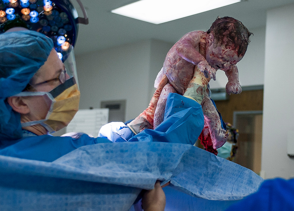 Third Place, Feature Picture Story - Logan Riely / Ohio UniversityAttending physician, Dr. Broecker, lifts Samantha Smith's 9 lb. 1 oz. baby boy over the curtain and shown to her for the first time.