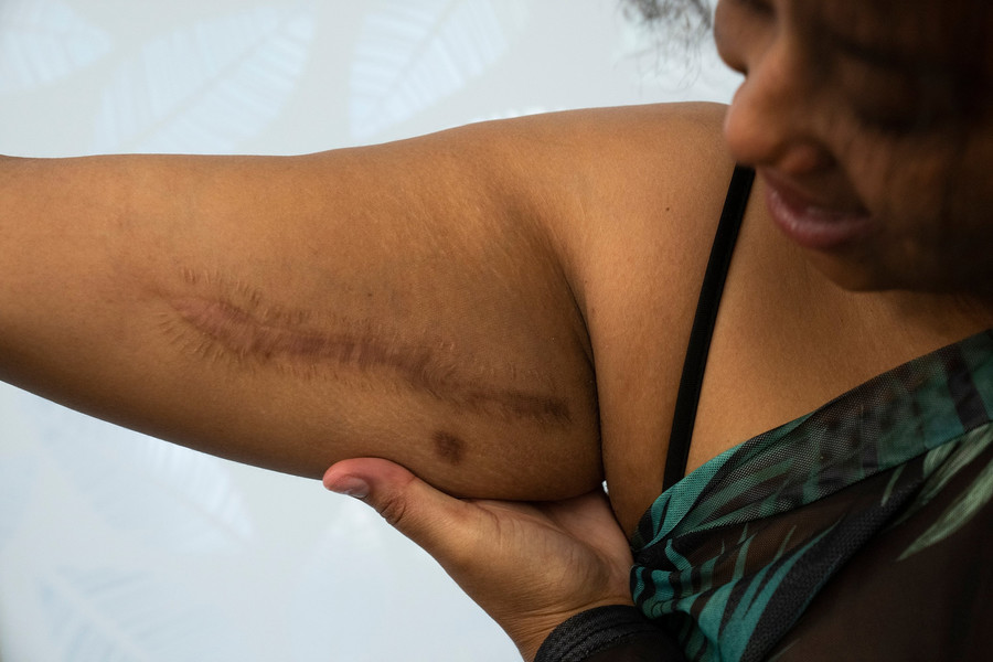 2nd - Photographer of the Year - Large Market Daliyah Brown shows a part of her arm during an interview that is scarred from surgeries. She was shot in 2022 but the physical, emotional and mental toll lingers for the 19-year-old. (Brooke LaValley / The Columbus Dispatch)